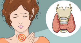 Bướu tuyến giáp to chèn ép lên thanh quản khiến người bệnh bị khàn tiếng