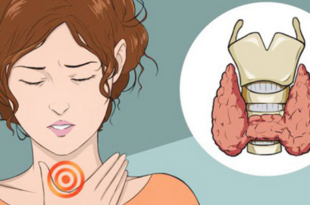 Bướu tuyến giáp to chèn ép lên thanh quản khiến người bệnh bị khàn tiếng