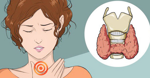 Bướu tuyến giáp to chèn ép lên thanh quản khiến người bệnh bị khàn tiếng