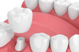LÀM THẾ NÀO ĐỂ HẾT SÂU RĂNG CÓ NHỮNG CÁCH ĐIỀU TRỊ NÀO