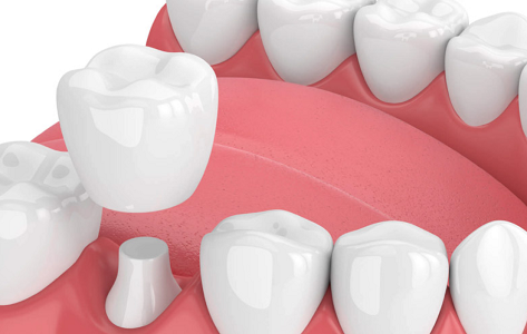 LÀM THẾ NÀO ĐỂ HẾT SÂU RĂNG CÓ NHỮNG CÁCH ĐIỀU TRỊ NÀO